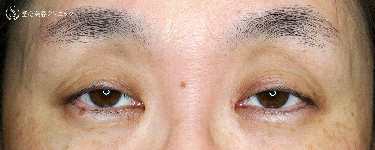 【40代女性・コンタクトレンズ下垂の第一選択】切らない眼瞼下垂+α法（2年6ヶ月後） Before 