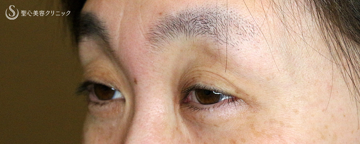 【40代女性・コンタクトレンズ下垂の第一選択】切らない眼瞼下垂+α法（4年後） Before 