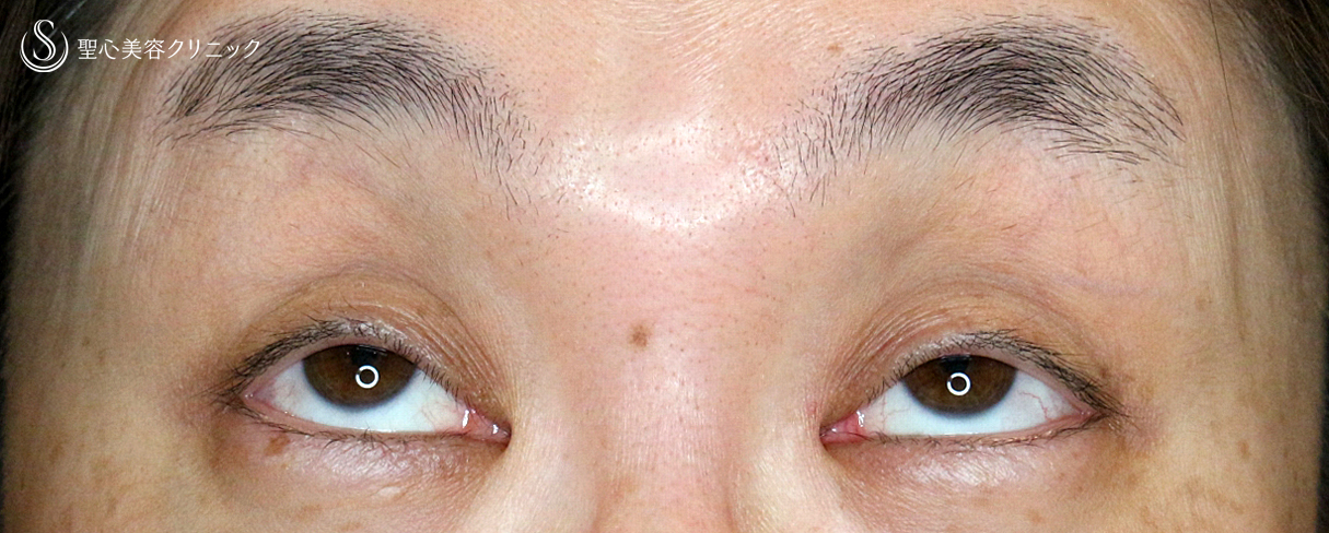 【40代女性・コンタクトレンズ下垂の第一選択】切らない眼瞼下垂+α法（4年後） Before 