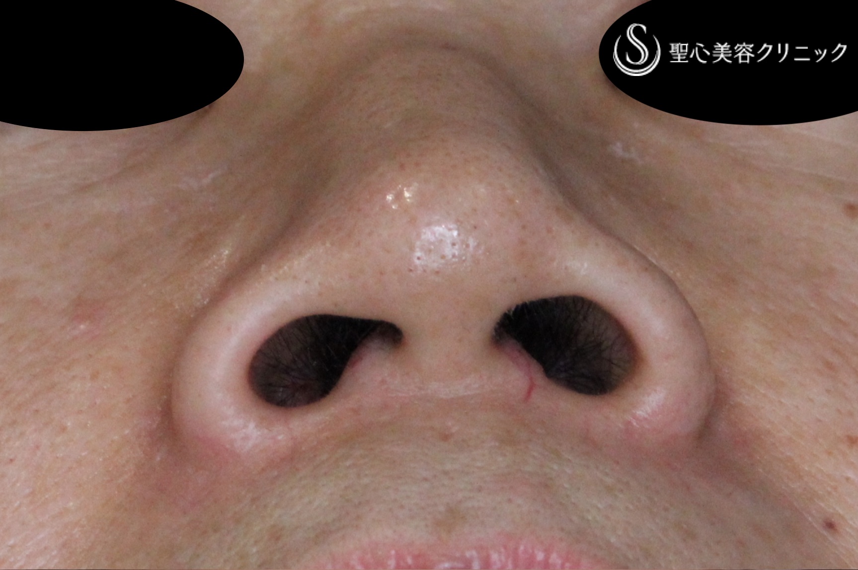 【60代女性・小鼻をすっきり】小鼻縮小術（2ヶ月後） Before 