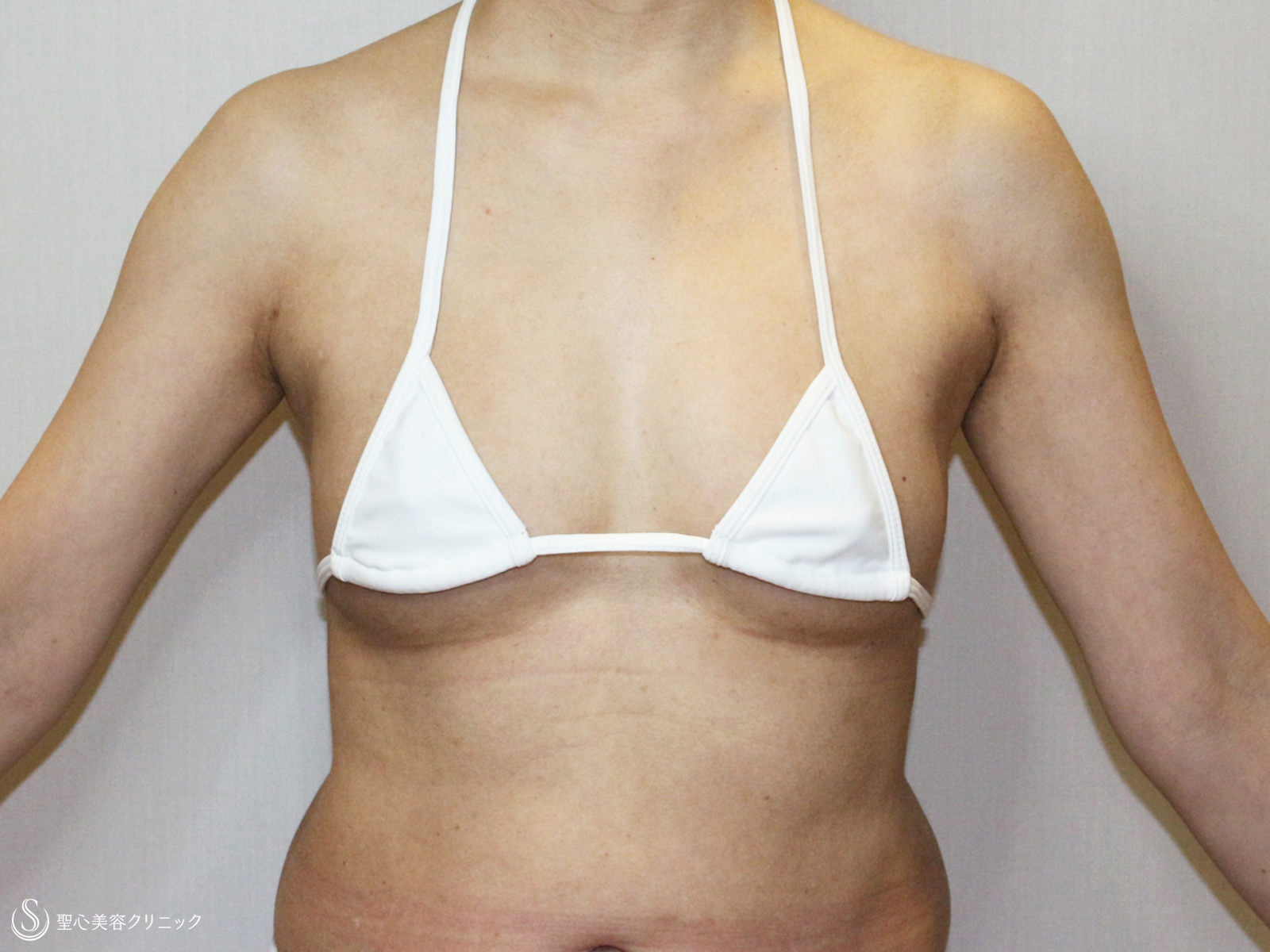 【48歳女性・最新の脂肪幹細胞豊胸】プレミアムセリューション豊胸術（3ヶ月後） After 