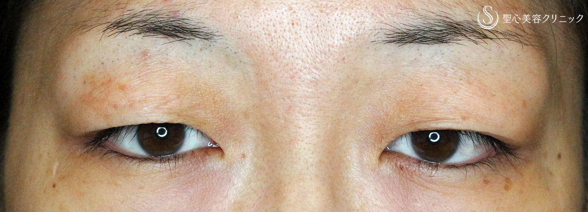 【30代女性・腫れぼったい瞼が激変】二重全切開+α法「Ver.4」（3ヶ月後） Before 
