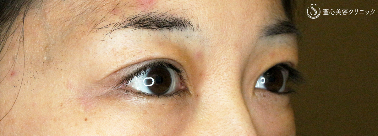 【30代女性・腫れぼったい瞼が激変】二重全切開+α法「Ver.4」（3ヶ月後） After 