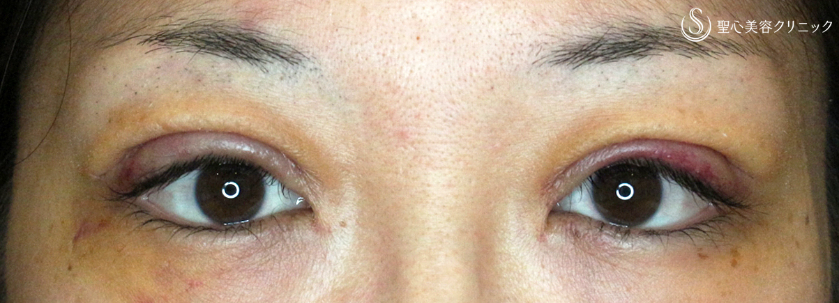 【30代女性・腫れぼったい瞼が激変】二重全切開+α法「Ver.4」（3ヶ月後） After 