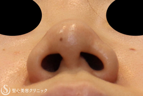 【20代女性・鼻先を細く下に向ける】鼻尖縮小+PCLドーム挿入（2週間後） Before 