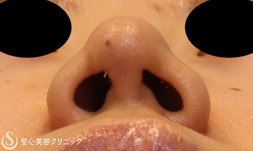 【20代女性・鼻先を細く下に向ける】鼻尖縮小+PCLドーム挿入（2週間後） After 