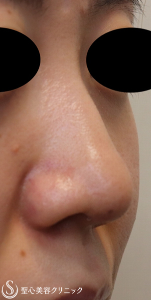 【20代女性・鼻先を細く下に向ける】鼻尖縮小+PCLドーム挿入（2週間後） After 