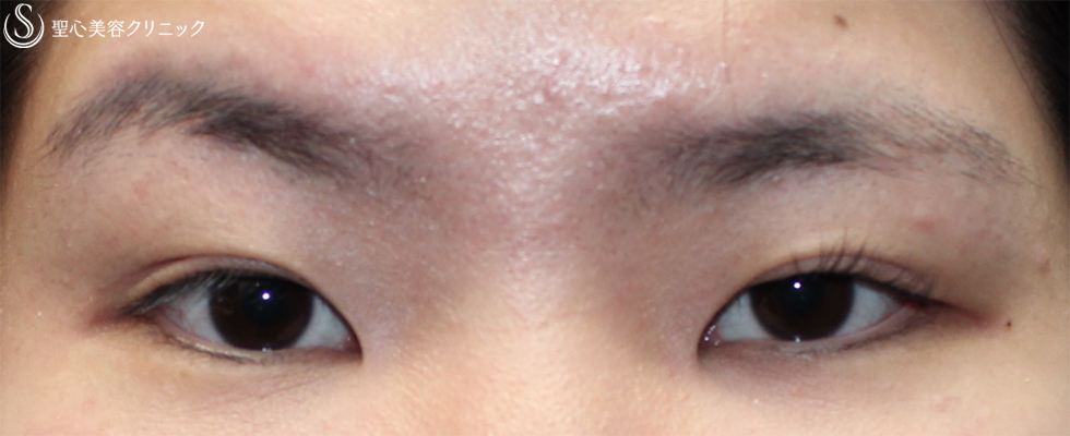 【20代女性・眉の形を埋没法で整える】マイクロメソッド＋α （１ヶ月後） Before 