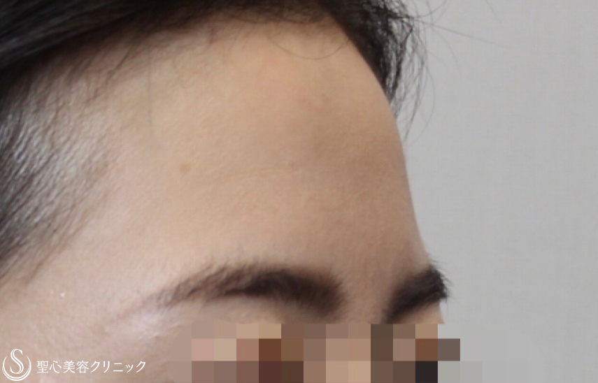 【20代女性・女性らしい綺麗な額に】プレミアムPRP皮膚再生療法（6ヶ月後） Before 