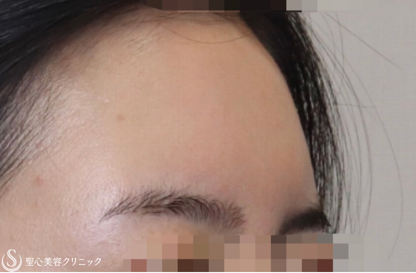 【20代女性・女性らしい綺麗な額に】プレミアムPRP皮膚再生療法（6ヶ月後） After 