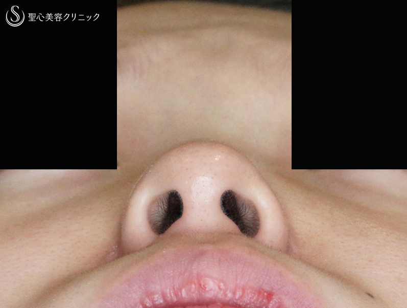 【20代女性・鼻の穴が見える...】小鼻縮小術+α法「Ver.4」（5ヶ月後） After 