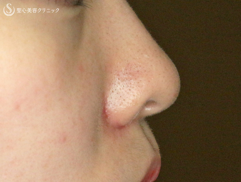 【20代女性・鼻の穴が見える...】小鼻縮小術+α法「Ver.4」（5ヶ月後） After 
