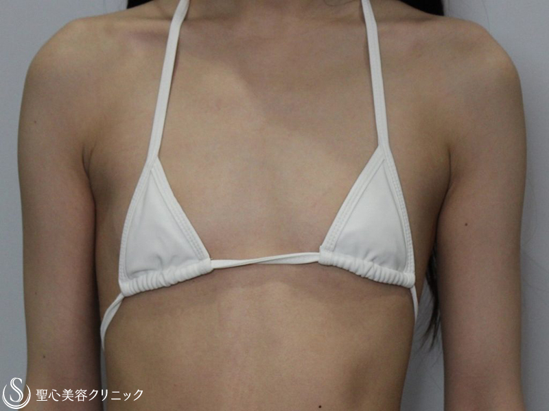 【20代女性・やせ型でも綺麗で大きなバストに！！】モティバエルゴノミクス300㏄筋膜下（3ヶ月後） Before 