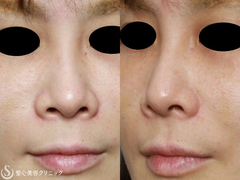 【30代女性・鼻先をスッキリと綺麗に】小鼻縮小+鼻尖縮小+耳介軟骨移植（1ヶ月後） Before 