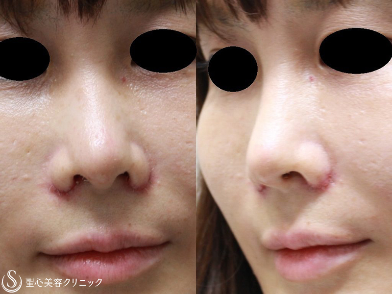 【30代女性・鼻先をスッキリと綺麗に】小鼻縮小+鼻尖縮小+耳介軟骨移植（1ヶ月後） Before 