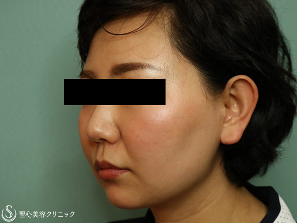 【30代女性・上品なEラインに】ヒアルロン酸注入（あご）（1ヶ月後） Before 