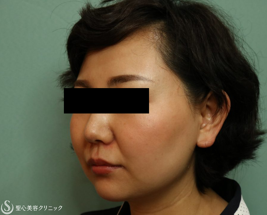 【30代女性・上品なEラインに】ヒアルロン酸注入（あご）（1ヶ月後） After 