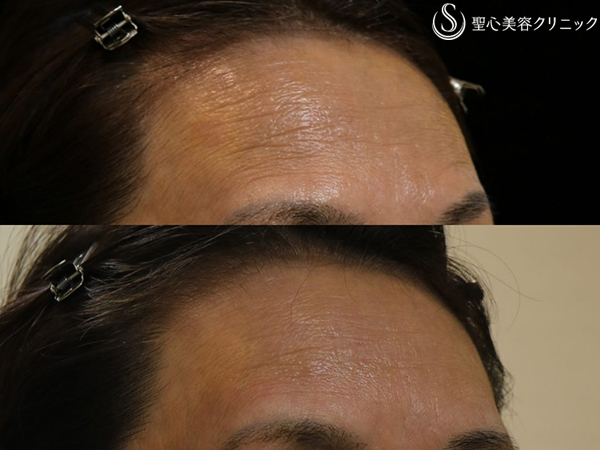 【60代女性・額のしわ】プレミアムPRP皮膚再生療法（1年半後） After 