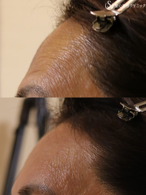 【60代女性・額のしわ】プレミアムPRP皮膚再生療法（1年半後） After 