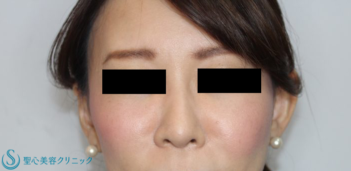 30代女性 眉間のシワ ボトックス注入 1ヶ月後 症例写真 美容整形 美容外科なら聖心美容クリニック