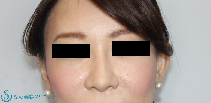 30代女性 眉間のシワ ボトックス注入 1ヶ月後 症例写真 美容整形 美容外科なら聖心美容クリニック
