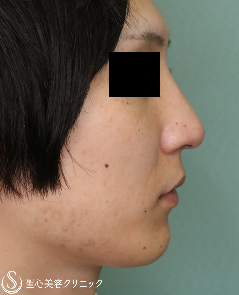 30代男性 わし鼻 耳介軟骨移植 1週間後 症例写真 美容整形 美容外科なら聖心美容クリニック 30代男性 わし鼻 耳介軟骨移植 1週間後 症例写真 美容整形 美容外科なら聖心美容クリニック