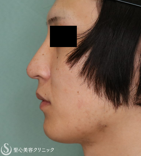 【30代男性・わし鼻】耳介軟骨移植（1週間後） After 