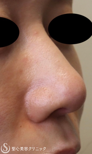 【20代女性・鼻先を整える】鼻尖縮小＋耳介軟骨移植（鼻尖形成）（2ヶ月後） After 