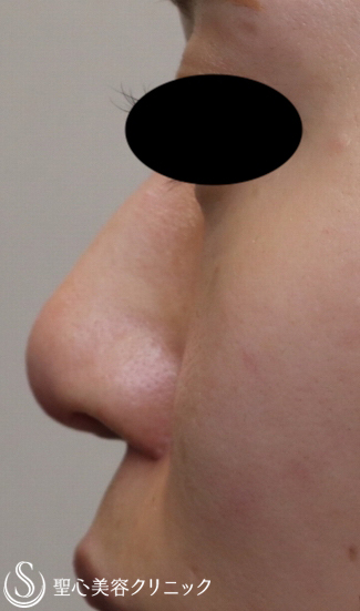 【20代女性・鼻先を整える】鼻尖縮小＋耳介軟骨移植（鼻尖形成）（2ヶ月後） Before 