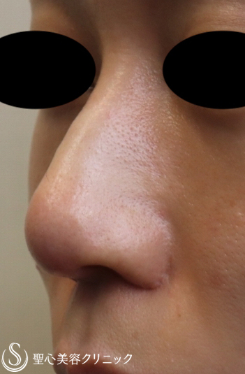 【20代女性・鼻先を整える】鼻尖縮小＋耳介軟骨移植（鼻尖形成）（2ヶ月後） Before 