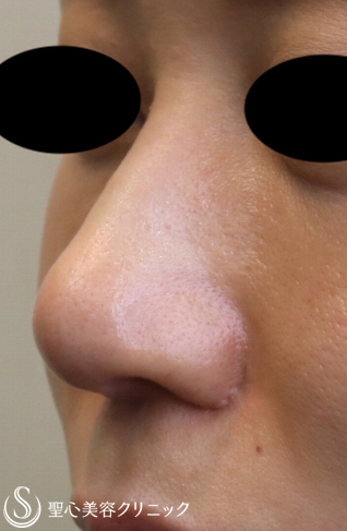 【20代女性・鼻先を整える】鼻尖縮小＋耳介軟骨移植（鼻尖形成）（2ヶ月後） After 