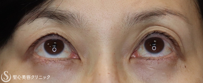 【50代女性・切らない眼瞼下垂で”まぶた”スッキリ】眼瞼下垂（埋没法）（1年後） After 