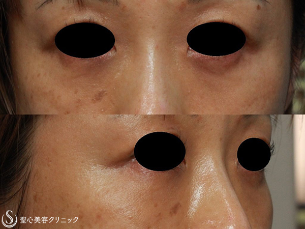 【40代女性・目の下のクマ、凹みの改善】プレミアムPRP皮膚再生療法（2年後） After 