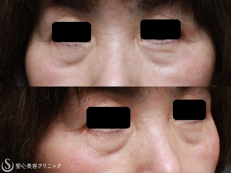 【60代女性・目の下のたるみ、膨らみ、凹みの改善】片側の脱脂+プレミアムPRP皮膚再生療法（1ヶ月後） Before 