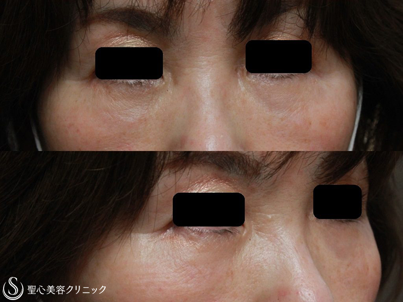 【60代女性・目の下のたるみ、膨らみ、凹みの改善】片側の脱脂+プレミアムPRP皮膚再生療法（1ヶ月後） After 