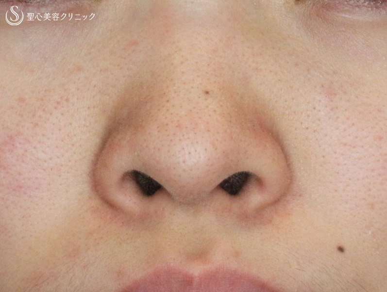 【20代女性・鼻の穴が見える...】小鼻縮小術+α法「Ver.4」（5ヶ月後） Before 