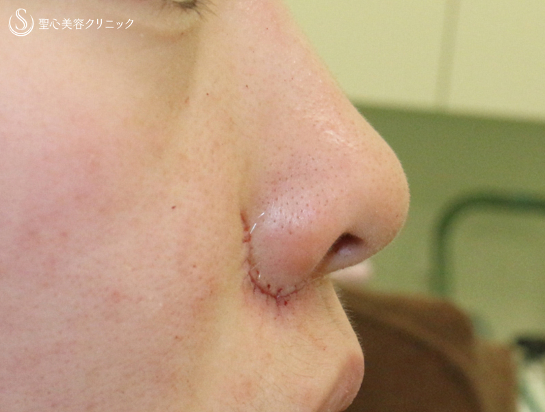 【20代女性・鼻の穴が見える...】小鼻縮小術+α法「Ver.4」（5ヶ月後） Before 