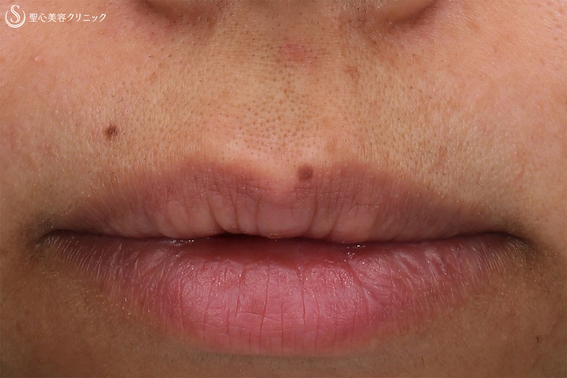 【30代女性・上唇のホクロ】ホクロ除去(電気凝固法)（３ヶ月後） Before 