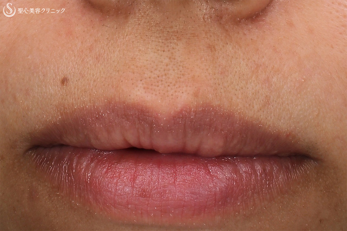 【30代女性・上唇のホクロ】ホクロ除去(電気凝固法)（３ヶ月後） After 