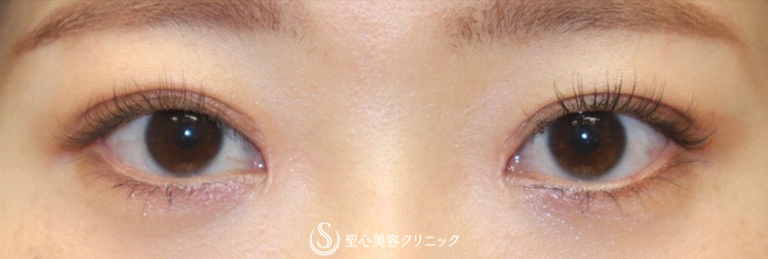【20代女性・平行型の二重で美人目に】目頭切開（術後3ヶ月） After 