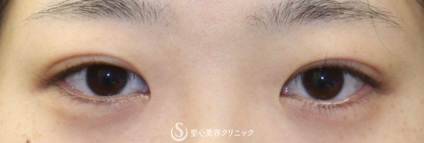 【20代女性・平行型の二重で美人目に】目頭切開（術後3ヶ月） Before 