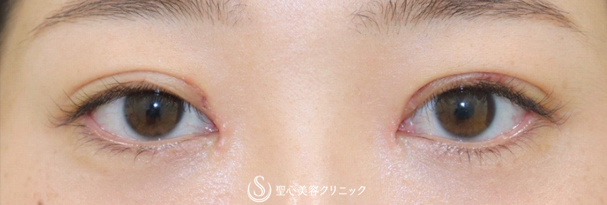 【20代女性・平行型の二重で美人目に】目頭切開（術後3ヶ月） After 