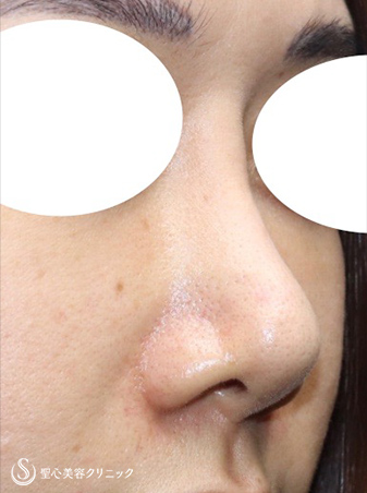 【30代女性・他院術後の修正手術】鼻尖修正術、プロテーゼ入れ替え（術後3週間） After 