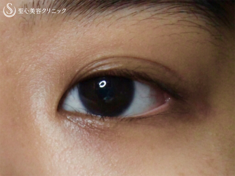 【20代女性・末広型の二重を綺麗な平行型に】目頭切開後（3ヶ月後） Before 