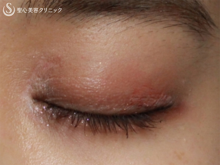 【20代女性・末広型の二重を綺麗な平行型に】目頭切開後（3ヶ月後） After 