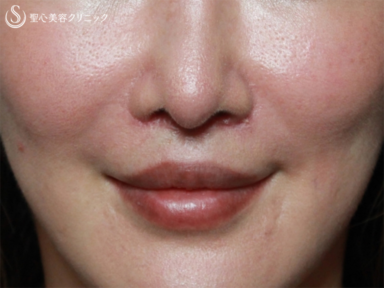 【40代女性・鼻下を短く整えて端正に＆若返り】リップリフト：人中短縮術（3週間後） After 