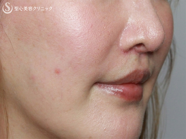 【40代女性・鼻下を短く整えて端正に＆若返り】リップリフト：人中短縮術（3週間後） After 