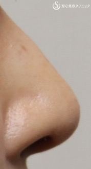 【30代女性・鼻先を高く】3D PCLドーム（1週後） After 
