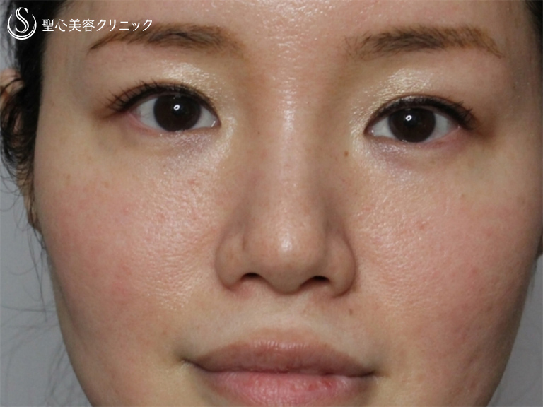 【女性・大阪院スタッフ】Ｇ-ｍｅｓｈ（メッシュ）で綺麗な鼻筋に！！（3ヶ月後） Before 