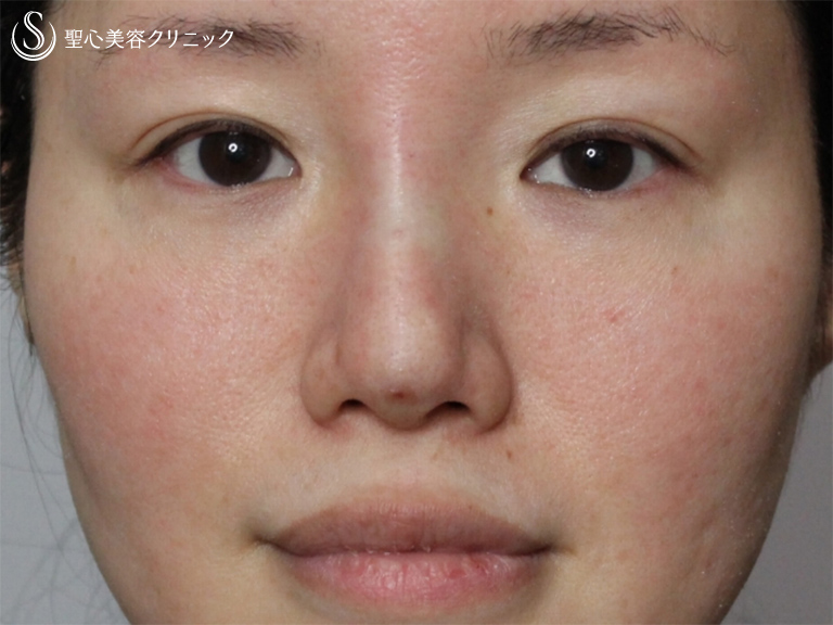 【女性・大阪院スタッフ】Ｇ-ｍｅｓｈ（メッシュ）で綺麗な鼻筋に！！（3ヶ月後） Before 